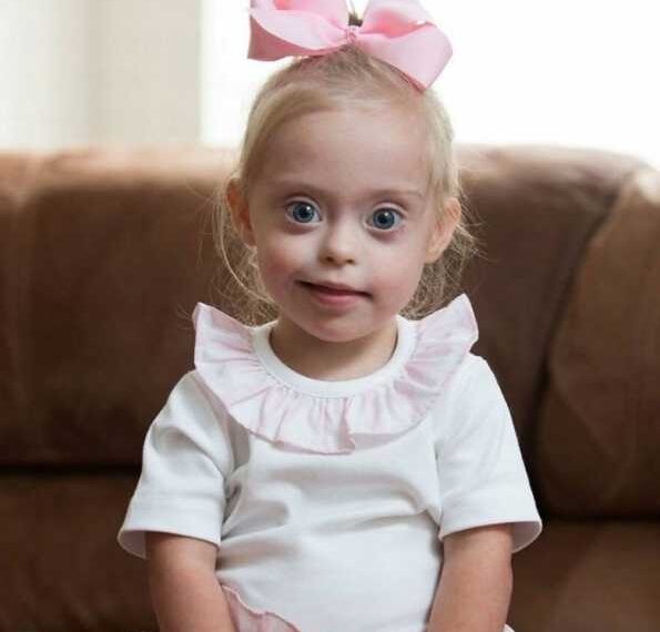 Чому люди з синдромом Дауна такі схожі один на одного?